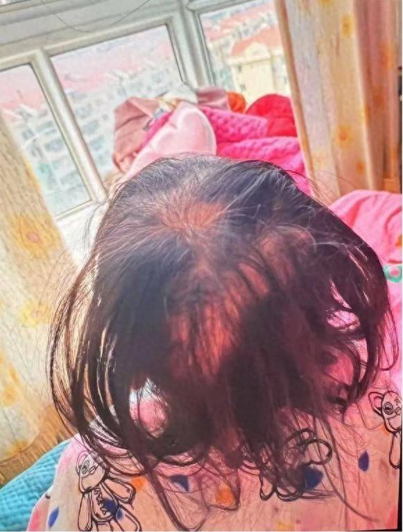 盈通策略 湖南3岁女童铊中毒，出现异常脱发与疼痛需注意